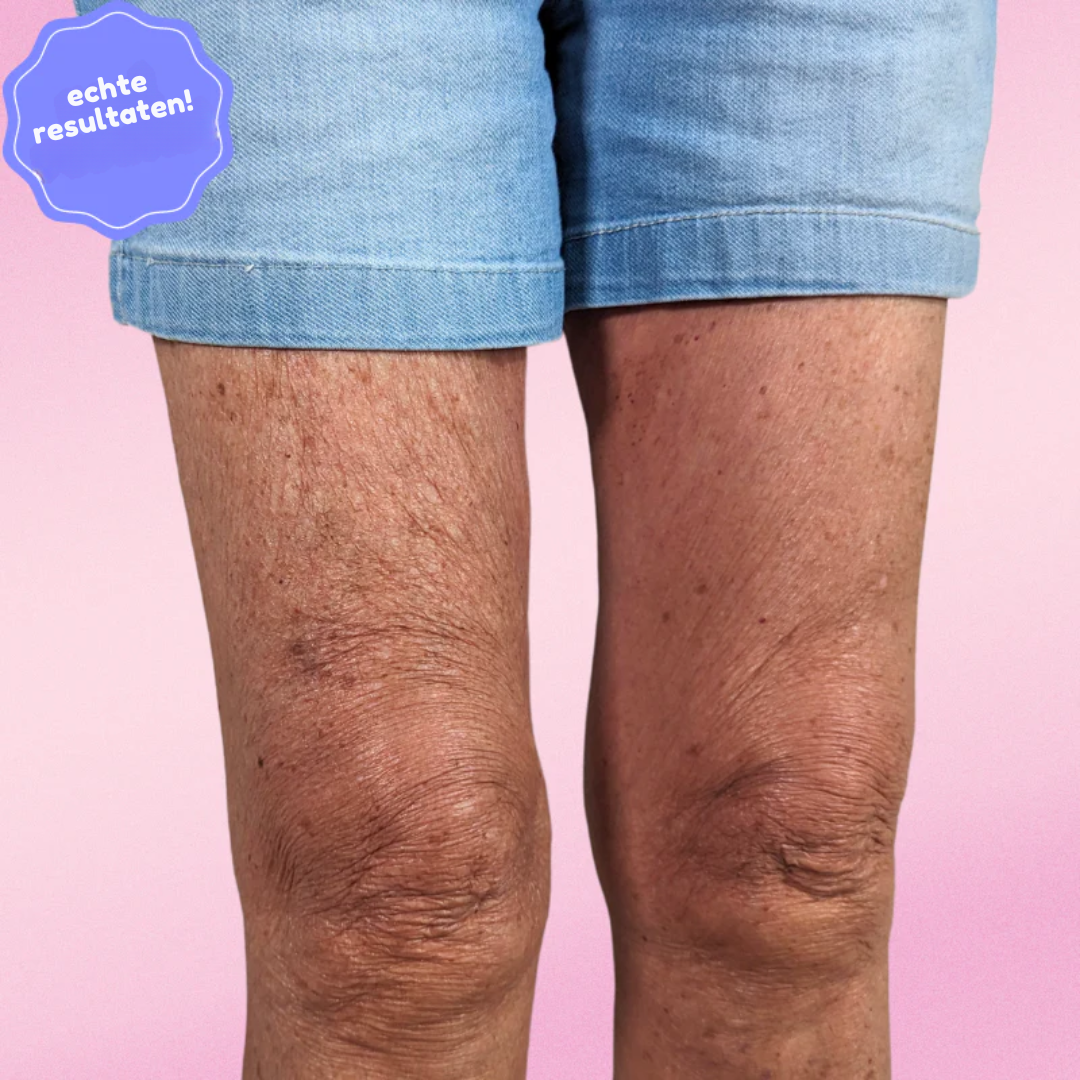 Lifttera – Cellulitis Tape
