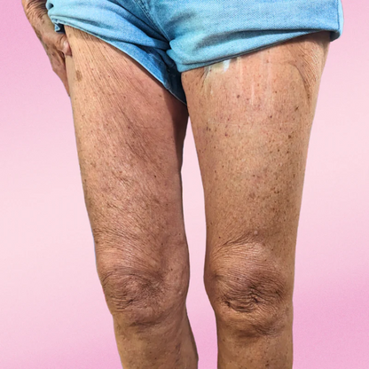 Lifttera – Cellulitis Tape