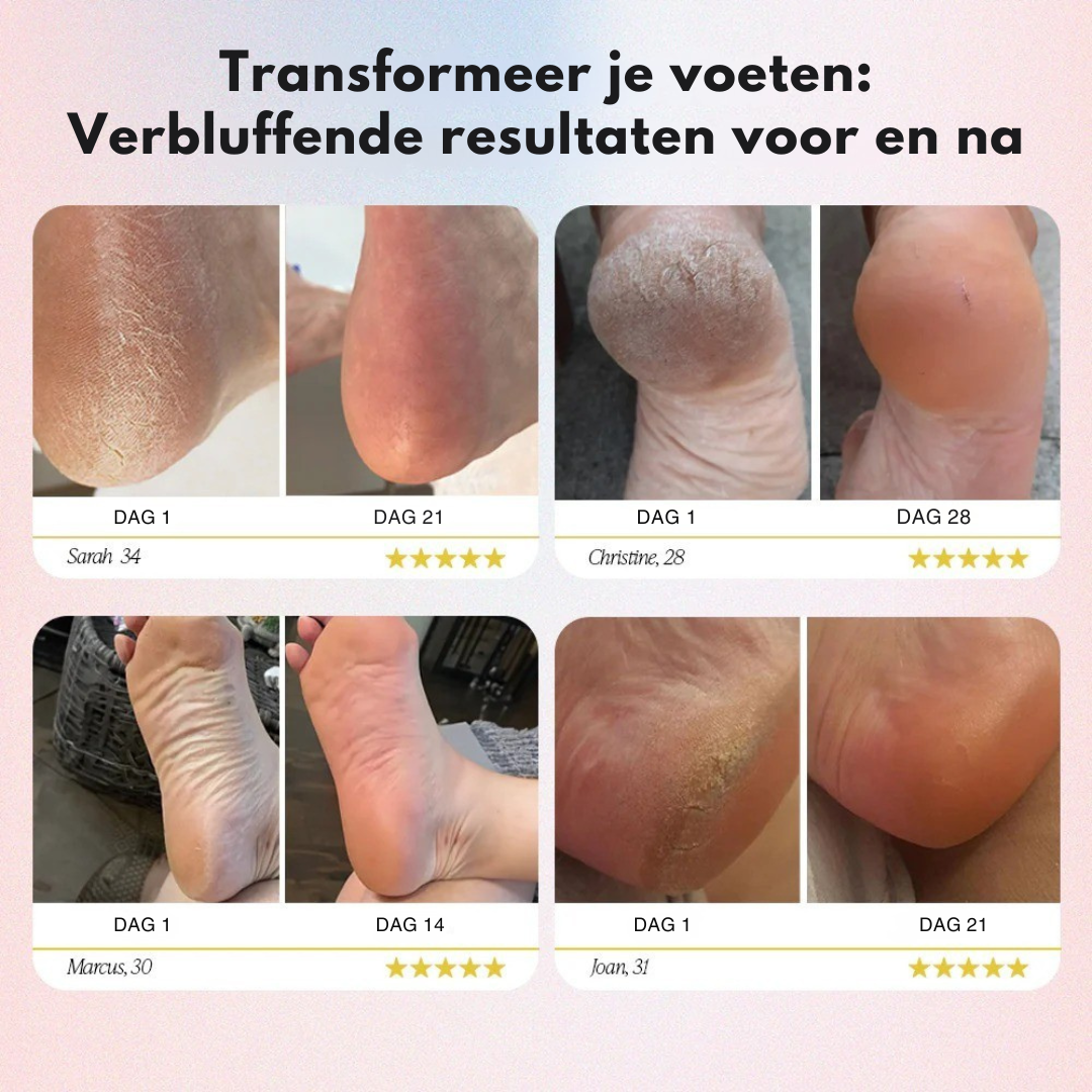 BareStap – Elektrische Eeltverwijderaa