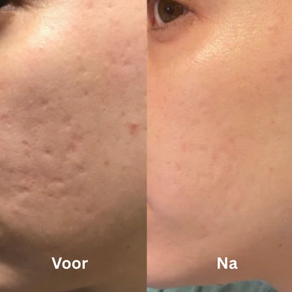 Barebliss – Medische siliconenplaten voor littekenverlichting