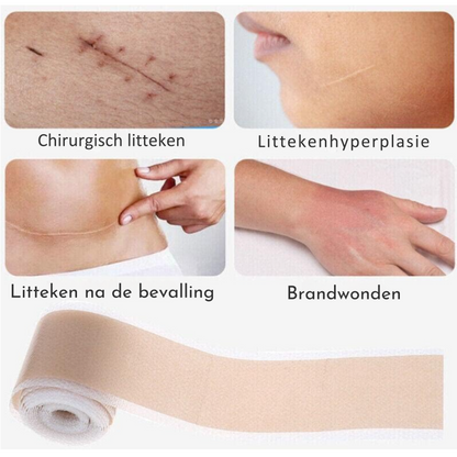 Barebliss – Medische siliconenplaten voor littekenverlichting